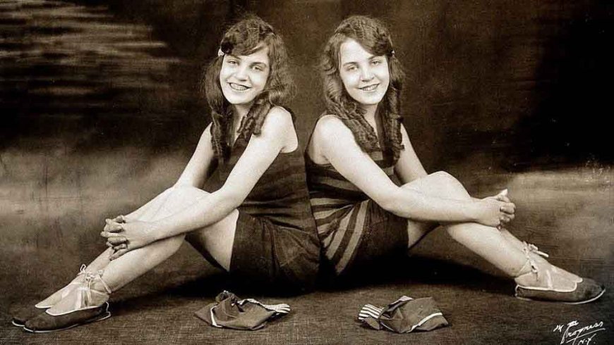 10 Most Fascinating Siamese Twins in History