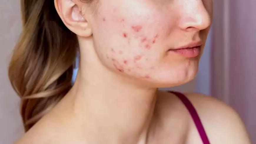 Hormonal Acne: The Connection Between Hormones and Skin Health